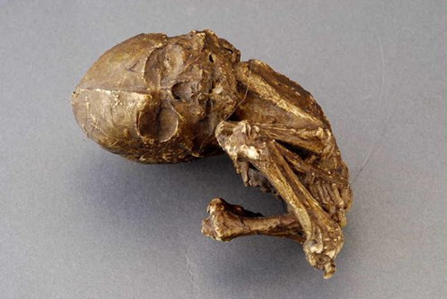 Thai vôi hóa (ảnh minh họa)