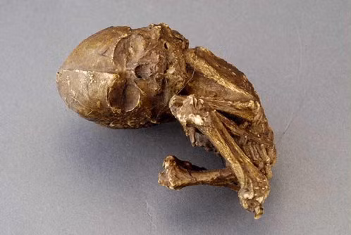 Thai vôi hóa (ảnh minh họa)