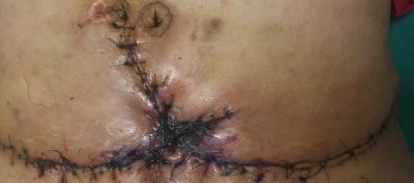 Rùng mình với màn cắt mỡ bụng kiểu 'tùng xẻo' của Spa