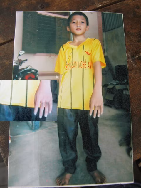 Những vết bầm trên tay cháu Hạnh mà gia đình tố do quá trình "hỏi cung" gây nên - Ảnh gia đình cung cấp.