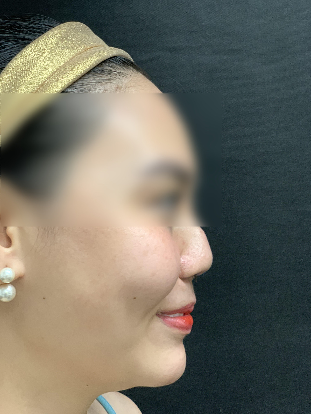 Mui gai xinh bien dang vi tham my hong den 8 lan-Hinh-3