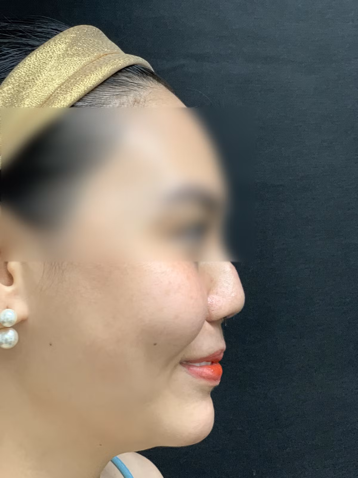 Mũi gái xinh biến dạng vì thẩm mỹ hỏng đến 8 lần - Hình 3 Mui gai xinh bien dang vi tham my hong den 8 lan-Hinh-3