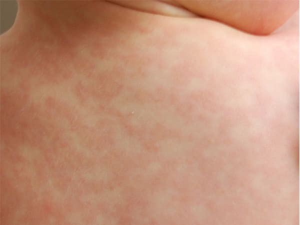  Phát ban nhiệt: Tiếp xúc lâu với ánh nắng mặt trời có thể gây các nốt phát ban đỏ và ngứa trên da. Bạn nên tránh ra ngoài khi thời tiết nóng ẩm, đồng thời tránh vận động mạnh để ngăn đổ quá nhiều mồ hôi.