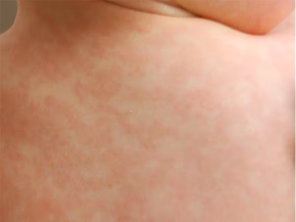  Phát ban nhiệt: Tiếp xúc lâu với ánh nắng mặt trời có thể gây các nốt phát ban đỏ và ngứa trên da. Bạn nên tránh ra ngoài khi thời tiết nóng ẩm, đồng thời tránh vận động mạnh để ngăn đổ quá nhiều mồ hôi.