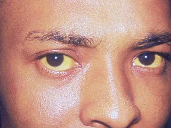  Vàng da: Nhiệt độ cao vào mùa hè làm tăng nguy cơ mắc bệnh vàng da. Bệnh này được gây ra do tích tụ chất thải bilirubin trong máu. Để phòng tránh, hãy uống đủ nước và ăn nhiều rau quả tươi.