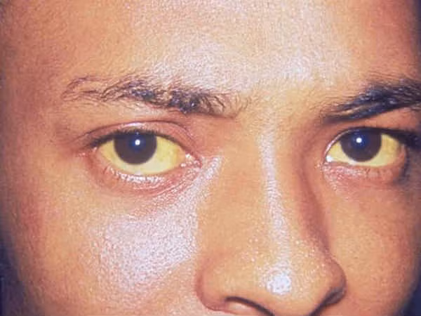  Vàng da: Nhiệt độ cao vào mùa hè làm tăng nguy cơ mắc bệnh vàng da. Bệnh này được gây ra do tích tụ chất thải bilirubin trong máu. Để phòng tránh, hãy uống đủ nước và ăn nhiều rau quả tươi.