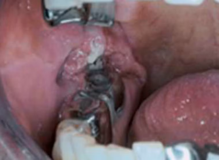 Răng chuyển màu và phần lợi bị lở loét là hậu quả của việc lạm dụng thuốc lá và rượu bia của một bệnh nhân ở tuổi 78. Bên cạnh việc chịu sự phiền toái từ khối u, hơi thở của bà cũng rất khó chịu khiến mọi người tỏ ra ngại ngần mỗi khi tiếp xúc.