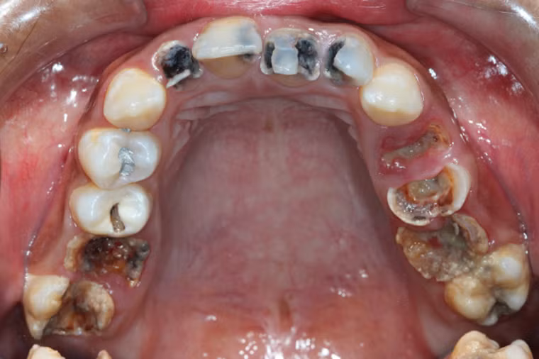 Sâu răng. Người cao tuổi thường dễ bị sâu răng do sử dụng nhiều đồ ngọt, ngại thăm khám răng miệng hay hạn chế trong việc tìm hiểu thông tin về các vấn đề nha khoa.