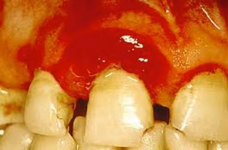 Các triệu chứng sớm của bệnh nướu bao gồm chảy máu nướu không đau. Nếu thấy đau, rất có thể bệnh đã tiến triển đến mức mất xương vùng xung quanh răng, dẫn đến sự hình thành túi nướu. Vi khuẩn trong các túi nướu gây nhiễm trùng, sưng, đau, và phá hủy xương, răng trên diện rộng. Thậm chí nó có thể gây mất răng. Song khoảng 90% các vấn đề về nướu dễ dàng được ngăn ngừa bằng việc vệ sinh răng miệng sạch sẽ.