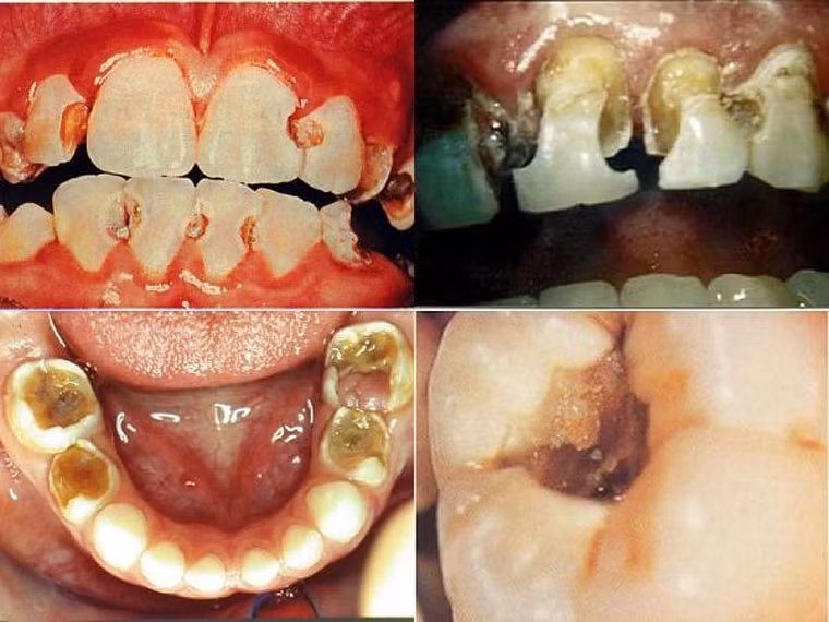 Mẻ răng. Vấn đề này bao gồm răng bị hư hỏng, mòn hoặc các vết hàn trước đây bị bong ra. Một trong những trường hợp gây đau đớn nhất là vụn răng cắm vào các mô mềm trong khoang miệng, gây viêm loét. Cảm giác nhức nhối này sớm được loại bỏ khi bạn đến các phòng khám nha khoa để gắp chúng ra. Nếu là mảnh răng nhỏ, đôi khi nó sẽ tự bung ra và vết loét sẽ lành.