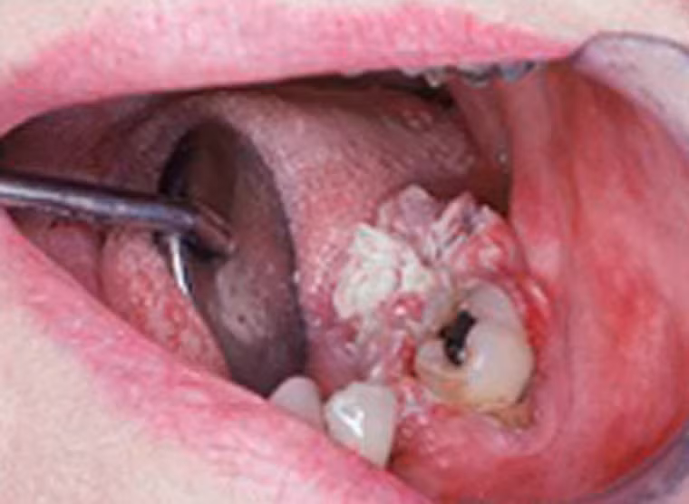 Hình ảnh cận cảnh ghi lại khối u ung thư Verrucous ở người phụ nữ 59 tuổi. Khối u không gây đau xuất hiện ngay cạnh một chiếc răng ở hàm dưới.