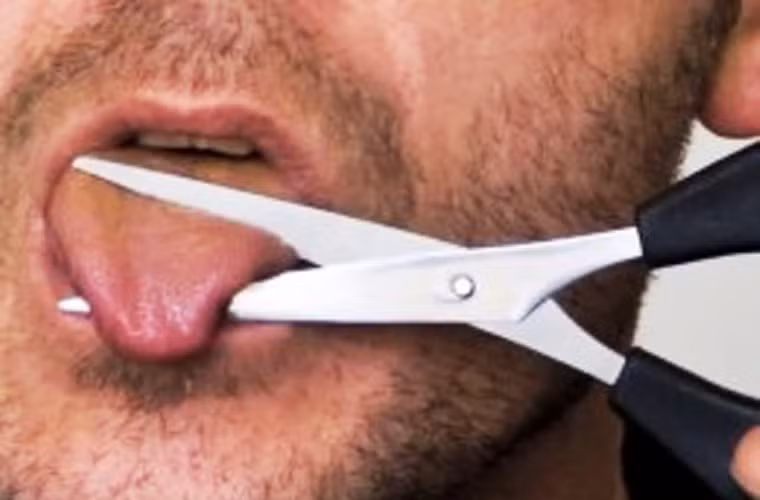 Khi phẫu thuật cắt bỏ ¾ lưỡi hoặc cắt lưỡi toàn phần bảo tồn thanh quản gây ảnh hưởng đáng kể đến chức năng nói. Lúc này, bệnh nhân có thể phát âm không đúng dù trước đây không hề nói ngọng.