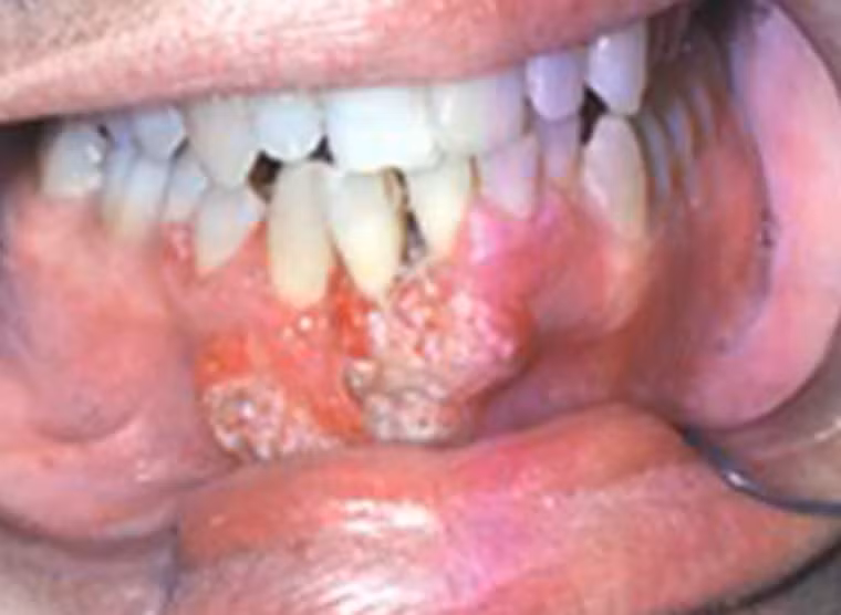 Còn đây là trường hợp của một bệnh nhân 55 tuổi, phần nướu bị tấn công bởi những khối u sần nhỏ, nó mở rộng phạm vi nhanh chóng, đặc biệt là khu vực môi dưới.