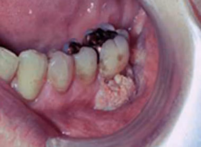 Nghiêm trọng hơn, người đàn ông này bị mắc ung thư biểu mô tế bào vảy dạng nhú. Khối u có màu trắng, gây lở loét. Nguyên nhân chính của căn bệnh cũng bắt nguồn từ thói quen hút thuốc lá.