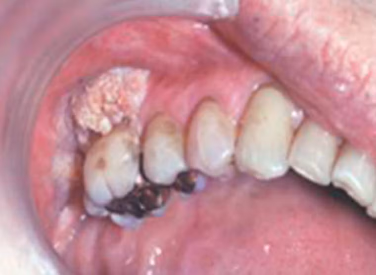 Người bệnh trong tấm hình được chẩn đoán bị nhiễm nấm (histoplasmosis), anh ta có một vết loét ở nướu và nó cũng có xu hướng ngày càng lan rộng.