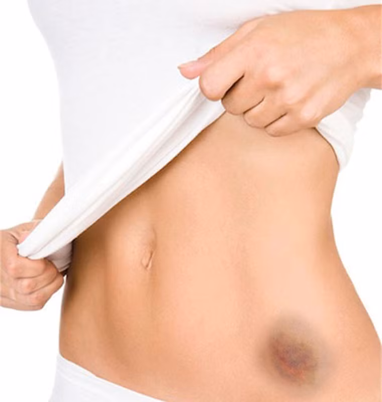 Đối với các tế bào máu: Khi thuốc ngấm vào cơ thể, nó tác động tiêu cực đến các tế bào máu, dẫn đến nhiễm trùng, bầm tím hay chảy máu dễ dàng. Cùng lúc, bệnh nhân thường cảm thấy cơ thể rã rời, mệt mỏi. Trong trường hợp cơ thể phản ứng quá mãnh liệt với thuốc, bạn cần thông báo cho bác sĩ để họ điều chỉnh giảm liều lượng hoặc dừng điều trị nếu cần thiết.