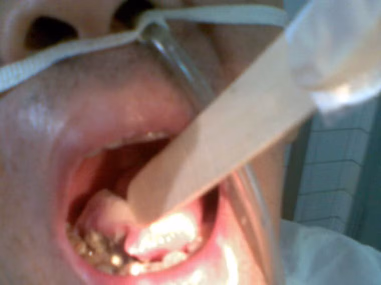 1 - Ung thư miệng: những chất độc có trong thuốc lá là một trong những yếu tố gây nguy cơ mắc các bệnh ung thư lưỡi, môi, nướu răng và cổ họng. Bộ Y tế Canada ước tính khoảng 3.400 trường hợp ung thư miệng ở nước này được phát hiện một năm, trong đó nam giới tỷ lệ lớn.