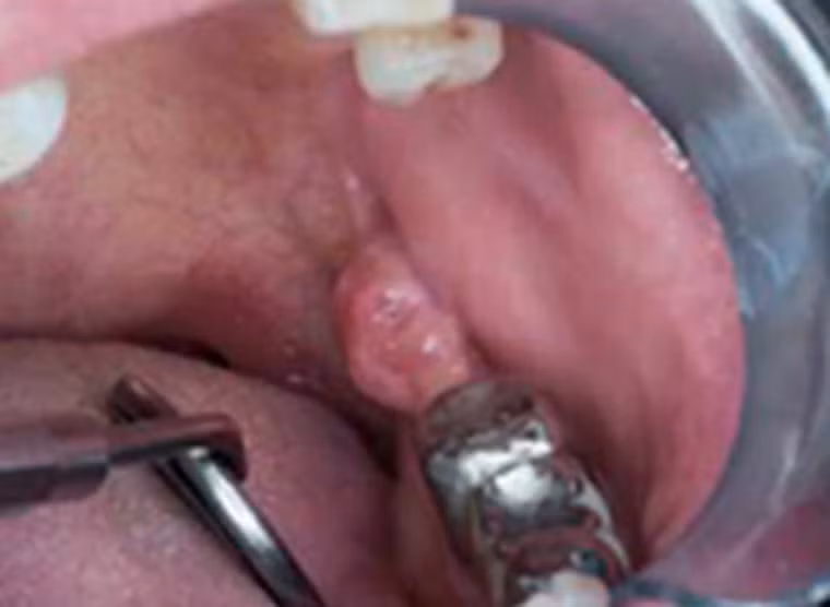 Khoang miệng của người đàn ông 64 tuổi cũng được chẩn đoán mắc ung thư biểu mô tế bào vảy. Song nguyên nhân chủ yếu là do thói quen thường xuyên hút thuốc lá.