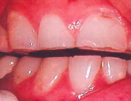 Thật không may, căn bệnh thường chỉ được phát hiện khi đã phát triển ở giai đoạn cuối. Nó cũng có khả năng gây biến dạng vẻ bề ngoài, làm ảnh hưởng nghiêm trọng đến chất lượng cuộc sống của bệnh nhân.