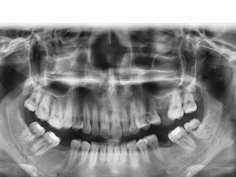 Chụp X- quang là phương pháp cho phép tạo ra các hình ảnh cấu trúc bên trong cơ thể khi sử dụng lượng nhỏ chất phóng xạ. Nếu người bệnh xuất hiện khối u bất thường, hình ảnh X – quang sẽ cho phép xác định vị trí, kích thước khối u. Một trong những lợi thế nữa của chụp X – quang là nó cho phép bạn mở rộng phạm vi kiểm tra ra các vùng như ngực, phổi, tuyến giáp… Rất nhiều trường hợp tình cờ phát hiện khối u khi chụp X – quang.