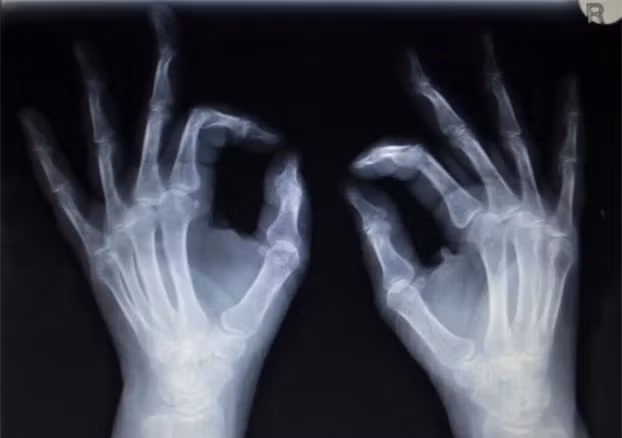 Khung xương yếu đi, nhẹ hơn: Lối sống hiện đại thiếu hoạt động thể chất khiến xương yếu và nhẹ hơn. Để tránh điều này, các nhà khoa học khuyến nghị cần hoạt động thể chất mỗi ngày.