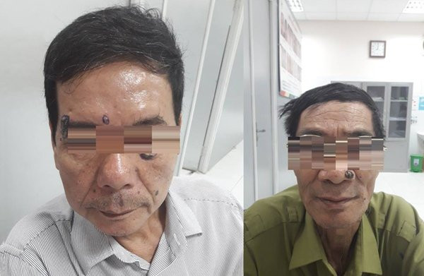 Ha Noi: Di dot not ruoi, 2 nguoi dan ong bat ngo phat hien ung thu