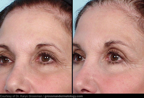 Trước và sau điều trị Thermage cho mắt: Những người bị mí sụp đặc biệt thích hợp điều trị Thermage. Kết quả sẽ xuất hiện sau 4-6 tháng điều trị, nhưng hiệu quả thì thực sự đáng kể.