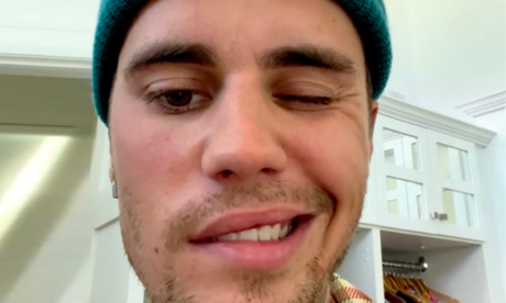 Loai benh hiem khien Justin Bieber bi liet nua mat nguy hiem ra sao?