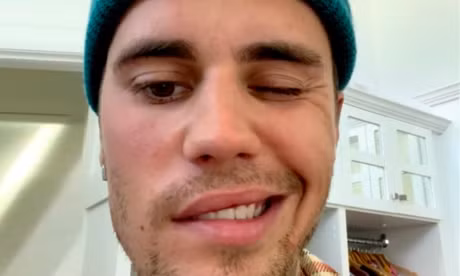 Loai benh hiem khien Justin Bieber bi liet nua mat nguy hiem ra sao?