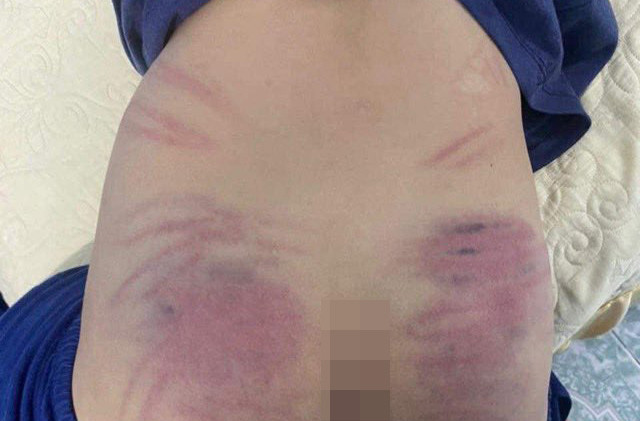 Hà Nội: Bé 9 tuổi chậm phát triển nghi bị cô giáo bạo hành dã man Ha Noi: Be 9 tuoi cham phat trien nghi bi co giao bao hanh da man