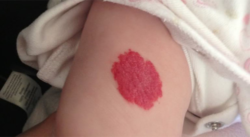 Vết bớt nằm ở đâu giúp mang lại tiền tài may mắn Vet bot nam o dau giup mang lai tien tai may man