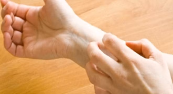 Dị ứng da. Thường thì bệnh nhân bị viêm da kích thích do tiếp xúc hóa chất, da bị tróc đỏ, rỉ nước, ngứa nhiều… nên rất khó chịu. Khi tầng thượng bì bị bong tróc ra, da không được bảo vệ, vì vậy lớp da non dễ bị nhiễm trùng, dễ bị dị ứng với những vật lạ như bụi, chất kích thích trong môi trường, hương liệu, nhất là những hương liệu dùng trong tắm xả…