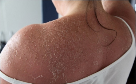 Nguy cơ làm teo da, ung thư da. Chưa dừng lại ở đó, các thành phần hóa chất dùng trong tắm trắng da nếu không được pha đúng nồng độ hoặc pha chế thêm các thành phần khác sẽ gây ra nhiều tác dụng phụ nguy hiểm như: bỏng, viêm, thậm chí là teo da, ung thư da.