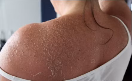 Nguy cơ làm teo da, ung thư da. Chưa dừng lại ở đó, các thành phần hóa chất dùng trong tắm trắng da nếu không được pha đúng nồng độ hoặc pha chế thêm các thành phần khác sẽ gây ra nhiều tác dụng phụ nguy hiểm như: bỏng, viêm, thậm chí là teo da, ung thư da.