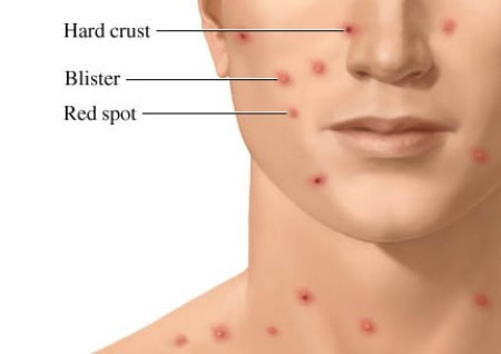 Mụn bóng nước lúc đầu chứa một chất dịch trong, khoảng 1 ngày sau trở nên đục như mủ rồi 2-3 ngày kế tiếp thì vỡ ra, các mụn sẽ đóng vẩy.