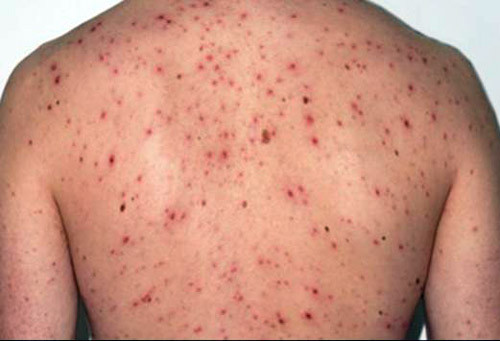 Biến chứng thường gặp nhất là bị nhiễm trùng tại các nốt đậu. Những người bị biến chứng này nếu không chữa trị kịp thời, tổn thương sẽ ăn sâu, lan rộng nên cho dù được chữa khỏi vẫn có thể để lại nốt sẹo rỗ gây mất thẩm mỹ, nặng hơn còn dẫn đến viêm mô tế bào, nhiễm trùng máu.