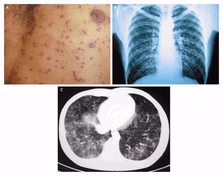 Biến chứng khác thường gặp là tổn thương thần kinh trung ương bao gồm những rối loạn ở tiểu não (rối loạn thất điều tiểu não, chóng mặt, run, rối loạn ngôn ngữ), viêm não (nhức đầu, co giật, rối loạn ý thức), tổn thương thần kinh...