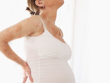 Cũng theo các bác sĩ, người mẹ mắc bệnh thủy đậu khi mang thai dưới 20 tuần sinh con ra sẽ có một tỉ lệ nhỏ (khoảng 2%) bị hội chứng thủy đậu bẩm sinh. Các biểu hiện của hội chứng này có thể là: sẹo da, nhẹ cân, các bệnh về mắt (đục thủy tinh thể, tổn thương võng mạc...), tay chân ngắn...