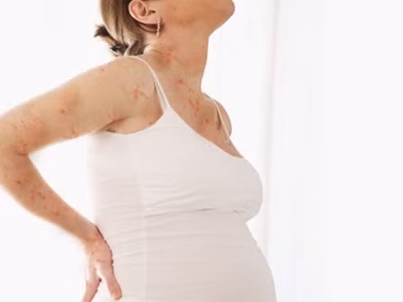 Cũng theo các bác sĩ, người mẹ mắc bệnh thủy đậu khi mang thai dưới 20 tuần sinh con ra sẽ có một tỉ lệ nhỏ (khoảng 2%) bị hội chứng thủy đậu bẩm sinh. Các biểu hiện của hội chứng này có thể là: sẹo da, nhẹ cân, các bệnh về mắt (đục thủy tinh thể, tổn thương võng mạc...), tay chân ngắn...