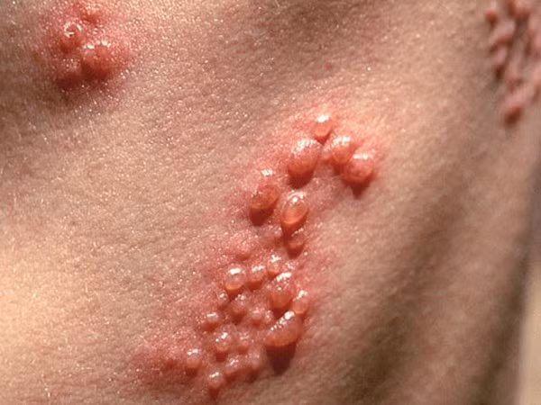 Đặc biệt, thậm chí sau khi bệnh nhân đã khỏi bệnh, siêu vi thuỷ đậu vẫn còn tồn tại trong các hạch thần kinh dưới dạng bất hoạt (ngủ đông). Nhiều năm sau đó, có thể là 10, 20, hay 30 năm sau, khi có điều kiện thuận tiện như sức đề kháng cơ thể kém hay có yếu tố gì khác, thì siêu vi này sẽ tái hoạt động trở lại và gây ra san thương của bệnh Zona, có người còn gọi là giời leo.