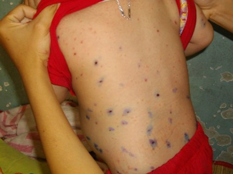 Nếu thấy nốt phỏng dạng nước đục chứ không có màu trong có nghĩa là có bội nhiễm vi khuẩn hoặc thấy trẻ ho, sốt tăng trở lại mệt hơn, đau đầu, nôn, trẻ chậm chạp hơn... thì cần đưa trẻ đến ngay bệnh viện. Rất có thể trẻ đã bị một trong các biến chứng hay gặp như: Viêm da, viêm phổi, viêm não-màng não.