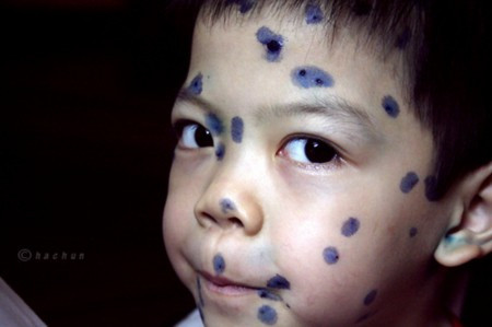 Bôi tràn lan Xanh methylen, nghệ tươi khắp người. Khi thấy con bị thủy đậu, không cần tư vấn của bác sĩ, nhiều bố mẹ nghĩ ngay đến việc bôi thuốc Xanh methylen chi chít cho con vào các nốt phỏng. Có người còn chọc cho nốt phỏng vỡ ra và bôi thuốc vào để “diệt tận gốc”. Tuy nhiên, khi nốt phỏng chưa vỡ, bôi thuốc là không cần thiết, trẻ không thích vì nhem nhuốc, thậm chí còn gãi thêm.