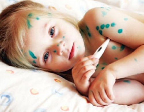 Chỉ khi nốt phỏng vỡ, chấm trực tiếp thuốc Xanh methylen vào nốt vỡ làm se nốt và ngừa bội nhiễm vi khuẩn, sát trùng khô nhanh. Chú ý không được bôi mỡ tetracyclin, mỡ penicillin hay thuốc đỏ. Ngoài ra cũng không nên chọc nốt phỏng ra vì không có tác dụng gì.