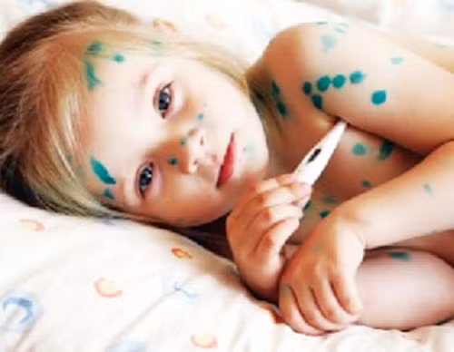 Chỉ khi nốt phỏng vỡ, chấm trực tiếp thuốc Xanh methylen vào nốt vỡ làm se nốt và ngừa bội nhiễm vi khuẩn, sát trùng khô nhanh. Chú ý không được bôi mỡ tetracyclin, mỡ penicillin hay thuốc đỏ. Ngoài ra cũng không nên chọc nốt phỏng ra vì không có tác dụng gì.