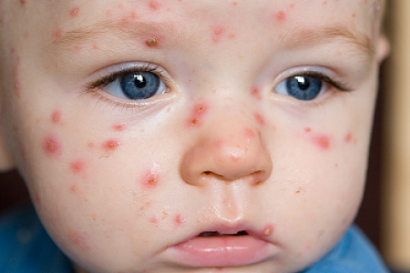 Thay vào đó, cha mẹ tắm cho con bằng nước ấm, chú ý không tắm lâu như khi trẻ khỏe mạnh. Ngoài ra, chú ý giữ sạch tay và cắt ngắn móng tay. Với trẻ nhỏ phải cho mang bao tay, xoa bột talc hoặc phấn rôm vô khuẩn khắp người để trẻ đỡ ngứa. Tránh gãi vì gãi làm nốt phỏng bị vỡ, có thể dẫn đến bội nhiễm vi khuẩn.