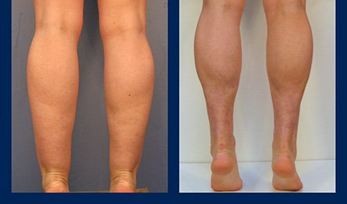 Một số bệnh nhân hài lòng với kết quả mổ. Khuyết điểm của phương pháp nầy là không biết trước được là cơ sẽ teo nhỏ bao nhiêu sau mổ? Một bất lợi khác của phương pháp nầy là to bù trừ của các cơ còn lại của bắp chân xảy ra nhiều năm sau ở một số bệnh nhân.