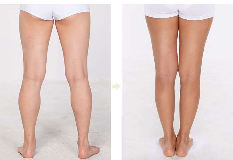 Chi phí cho một cuộc phẫu thuật dạng này từ 5.000 đến 10.000 USD và có thể gặp khó khăn khi đi bộ khoảng 2 tuần. Đó là chưa kể đến việc gặp phải những biến chứng không mong muốn.