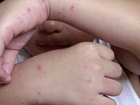 Nếu gia đình có nhiều trẻ cùng chung sống, nên cách ly tuyệt đối giữa trẻ lành và trẻ bệnh bằng nhiều cách tùy theo hoàn cảnh gia đình như giởi trẻ lành tạm thời ở một nơi khác, khuyến khích trẻ bệnh không nên chơi chung với trẻ lành, cần giám sát chặt chẽ các hoạt động của trẻ bệnh trong sinh hoạt thường nhật…