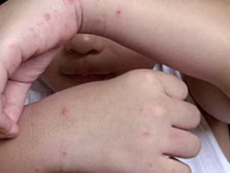 Nếu gia đình có nhiều trẻ cùng chung sống, nên cách ly tuyệt đối giữa trẻ lành và trẻ bệnh bằng nhiều cách tùy theo hoàn cảnh gia đình như giởi trẻ lành tạm thời ở một nơi khác, khuyến khích trẻ bệnh không nên chơi chung với trẻ lành, cần giám sát chặt chẽ các hoạt động của trẻ bệnh trong sinh hoạt thường nhật…