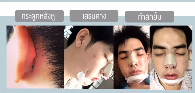 Sửa mũi, đột cằm, sửa tai.